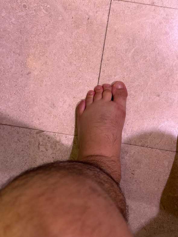 Swelling feet 2