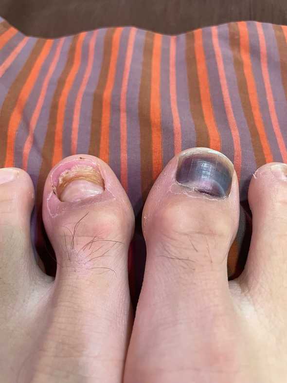 Chipped-off toe nails